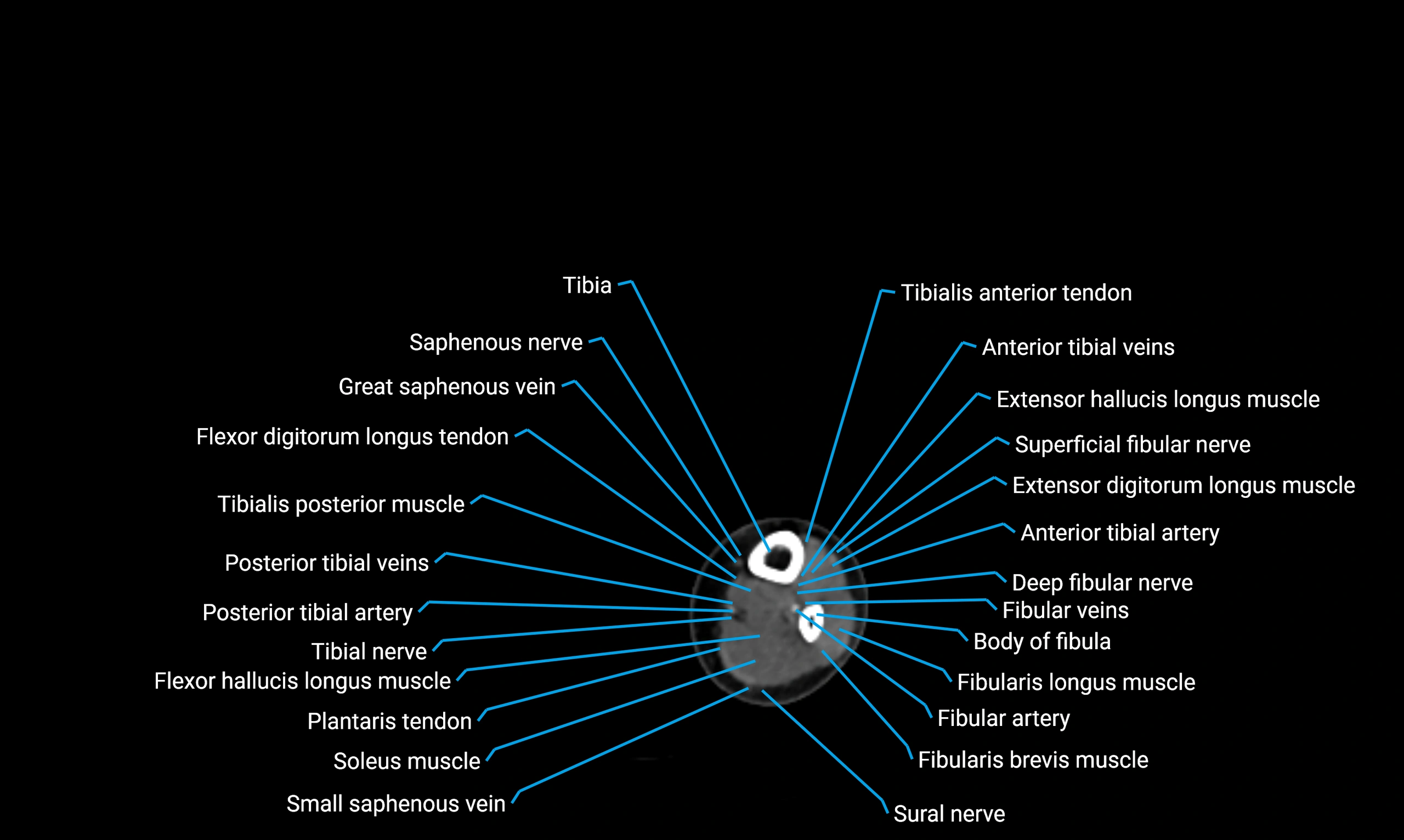 CT lower limb axial cross sectional anatomy labelled image 147 (2).webp